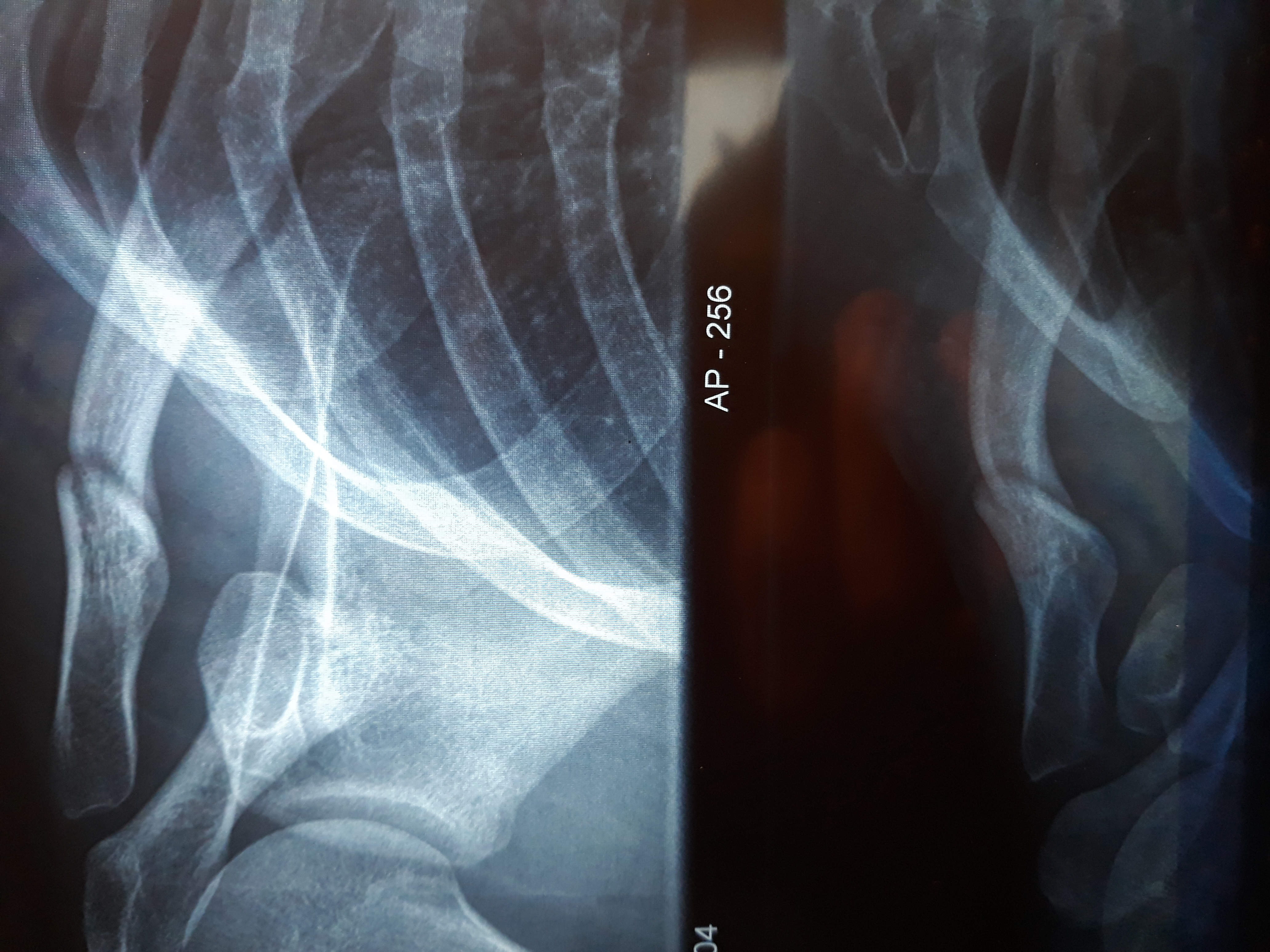 Nans Peters | Fracture de la clavicule Nans Peters | Fracture de la clavicule